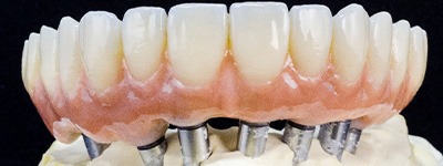 Example of implant dentures in Chaska