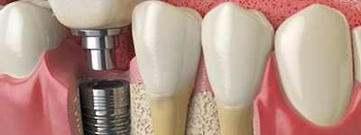 a digital illustration showing a dental implant fused to the jawbone