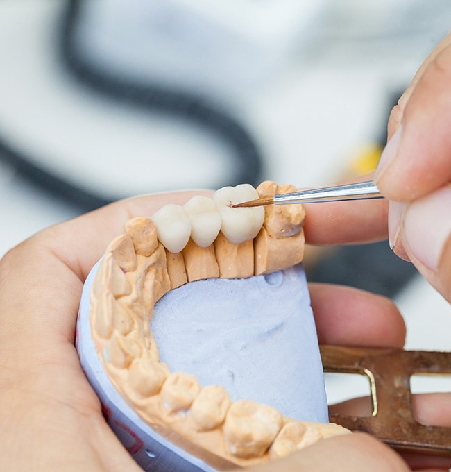 Close-up of dental bridge for replacing missing teeth in Chaska