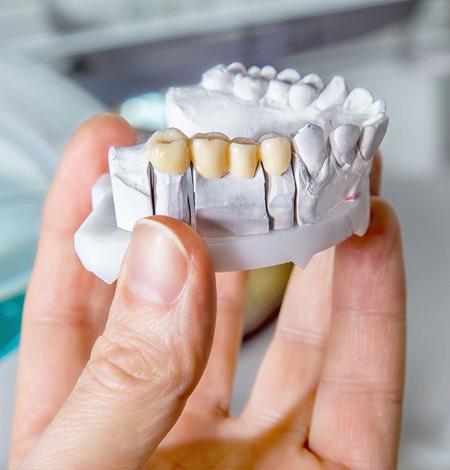 Model of dental bridge in Chaska