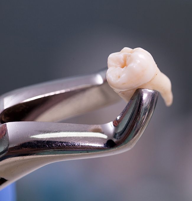 model of a dental implant in Chaska being placed in a patient’s mouth