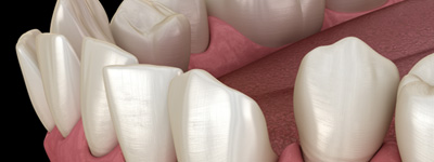 Illustration of gapped teeth