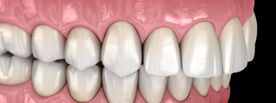 Illustration of an overbite