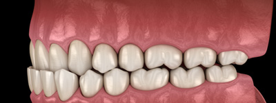 Illustration of an underbite