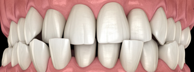 Illustration of a crossbite