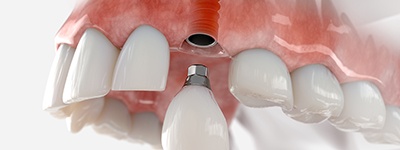 a 3D illustration showing the dental implant process