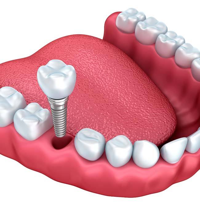 model of a dental implant in Chaska being placed in a patient’s mouth