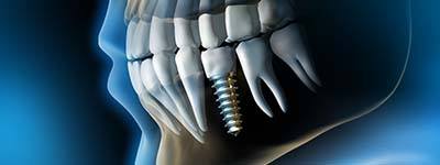 X-ray of a patient with a dental implant