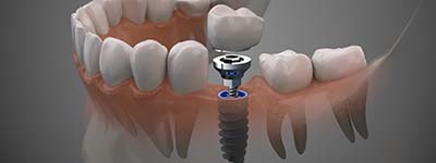 model of a single dental implant with a crown