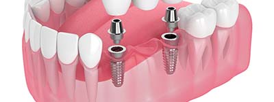 two dental implants securing a dental bridge into place