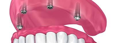 four dental implants supporting a full denture