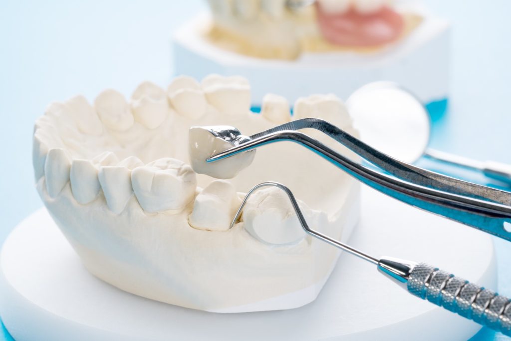 Dental tools holding dental crown over mold of teeth