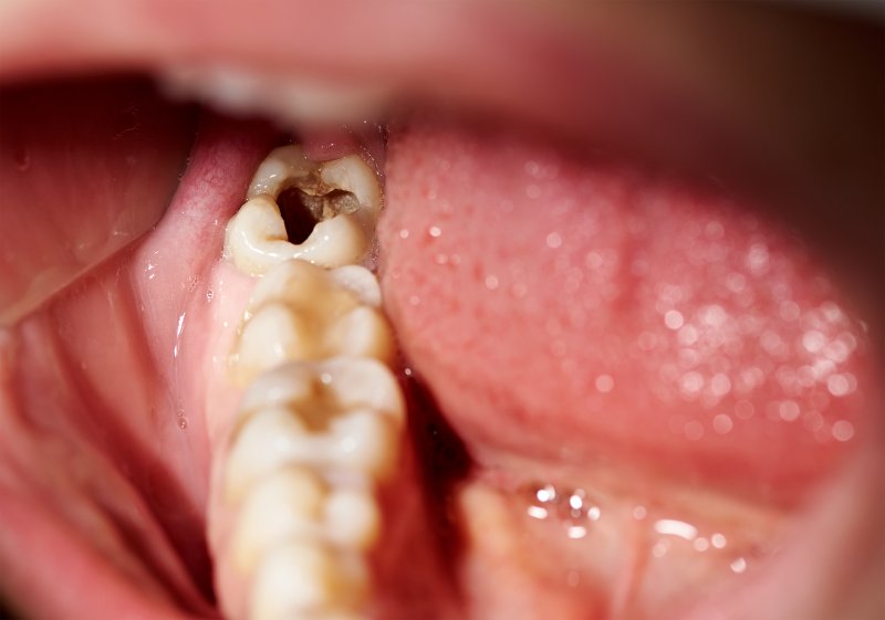 A closeup of a damaged tooth with a cavity
