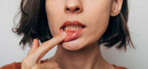 Closeup of someone with inflamed gums