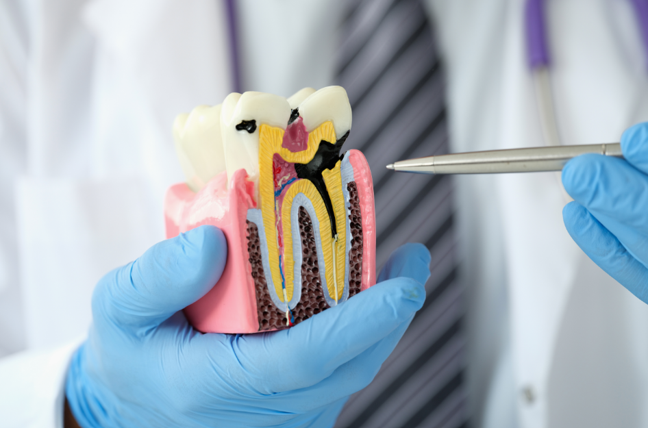 Dentist holdind tooth model, showing cavity