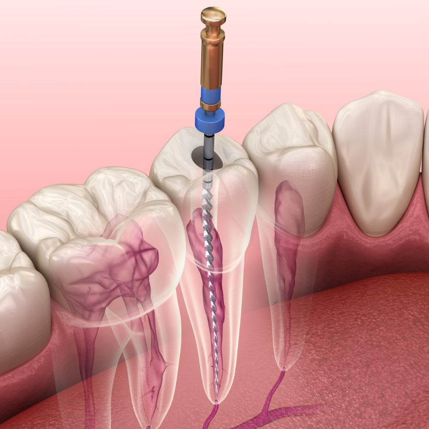 Illustrated cross section of a root canal